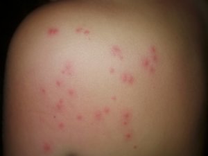 sandfly bites Southeast Asia